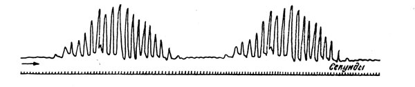 Рис.9. Типичное чейн-стоксово дыхание у больного, отравившегося морфином (по М.П. Николаеву)