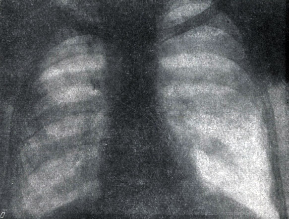Рис.76. б - Рентгенограмма больного Х. после лечения фтивазидом (по П.А. Ананьеву)
