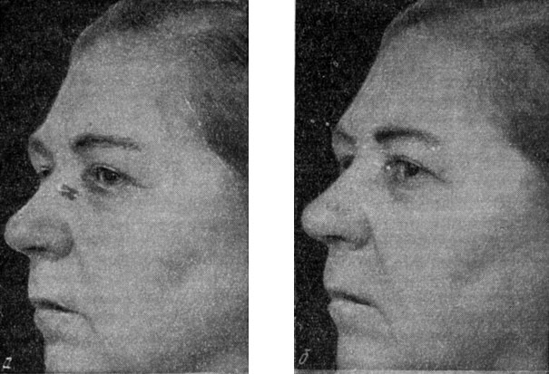 Рис.82. Рак кожи. а —  больная Н. Базилома на боковой поверхности носа; б — та   же  больная после лечения колхаминовой мазью (по К. Ш.  Кочкаревой)