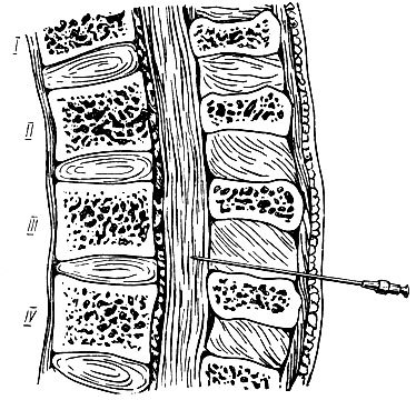 5. Введение лекарственных растворов в спинномозговой канал через межпозвоночный диск (I, II, III, IV - номера позвонков поясничного отдела позвоночного столба)