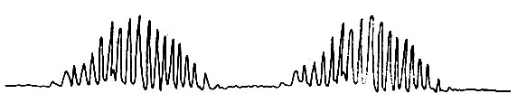 79. Типичное дыхание Чейна-Стокса при отравлении морфином (по М. П. Николаеву)