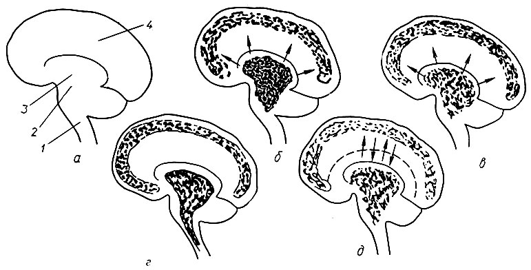 95. Схема действия различных угнетающих веществ (по П. П. Денисенко): а - схема мозга: 1 - продолговатый мозг; 2 - подбугорная область; 3 - зрительный бугор; 4 - большие полушария; б - действие аминазина; в - действие резерпина; г - действие мепротана; д - действие центральных холинолитических средств