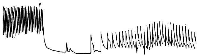 174. Влияние ацетилхолина на деятельность сердца собаки на фоне действия морфина (по В. В. Васильевой). В вену введен 1 мл 0,1% раствора ацетилхолин-хлорида (сердце остановилось, а затем отчетливо видна брадикардия)