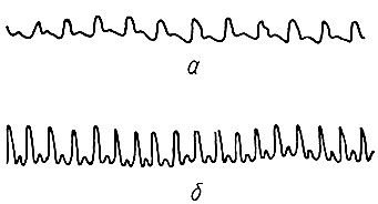 313. Сфигмографические кривые пульса у здорового человека (по А. И. Мироненко): а - исходные данные; б - после вдыхания амилнитрита. Частота сердечных сокращений увеличилась почти в два раза