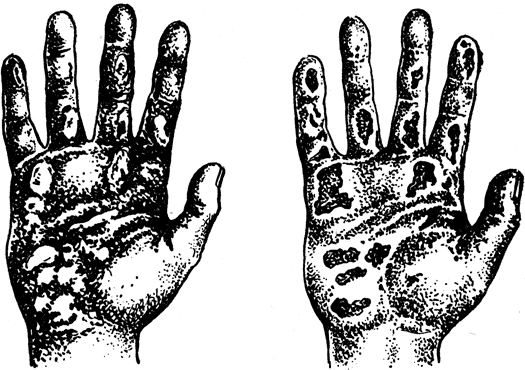 Рис. 74. Поражение ящуром рук у человека: слева - на ладони видно много пузырьков; справа - видны язвы